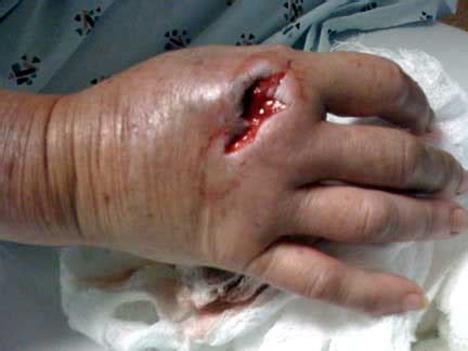 A cat bite can be just a cat bite, but a cat bite wound can be significantly more serious. cat bite Archives - Jeffrey Sterling, MD