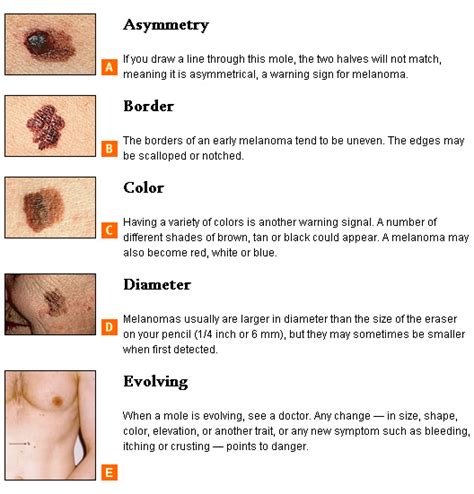 How To Tell If You Have Skin Cancer Encognitivecom