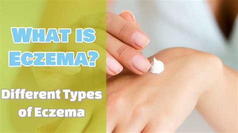 What Is Eczema And Different Types Of Eczema