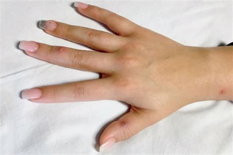 Tiny Blisters On Woman S Hand Turn Out To Be Sign Of Gonorrhoea That S Spread Through The Body