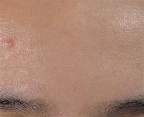 Blind Pimple 5 Easy Home Remedies To Remove Them From Your Skin