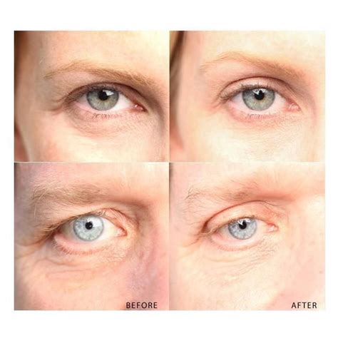 Anti Aging Eyelid Tape Contains 100 Strips Uniquelebal Eyelid