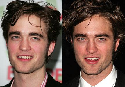 Did Robert Pattinson Have Plastic Surgery Nose Job Before And After