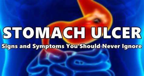 Stomach Ulcer Signs And Symptoms You Should Never Ignore