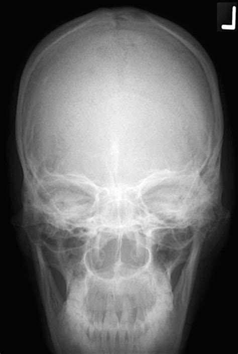 Skull Radiology Study Aids