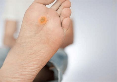 Childhood Warts How To Safely Treat And Prevent Them