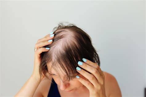 Medanta Alopecia Areata Causes Symptoms And Treatment