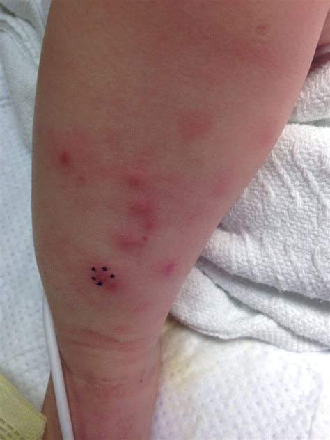 Pustular Vesicular Lesions On Extremities Trunk In Infant Female