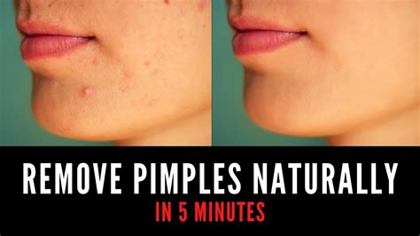 How To Remove Pimples Naturally At Home Remove Pimples In 5 Minutes