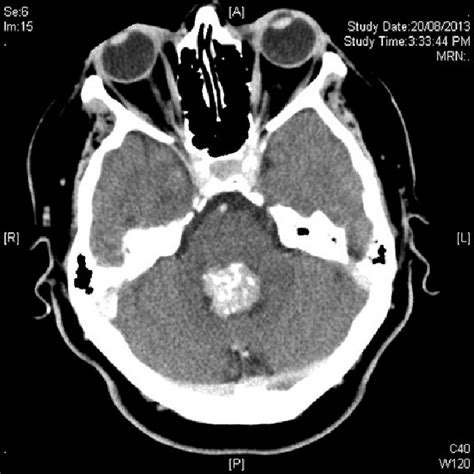 Axial Ct Scan Showing Hyperdense Fourth Ventricle Mass Lesion With My