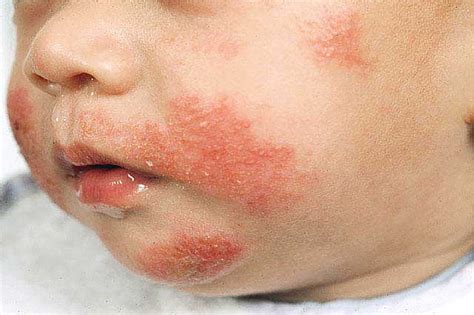 Baby Skin Allergy Allergy Medik