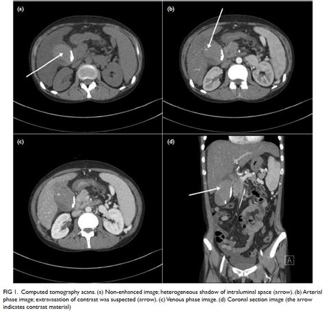 Unusual Gallbladder Disease Spontaneous Gallbladder Haematoma Hkmj