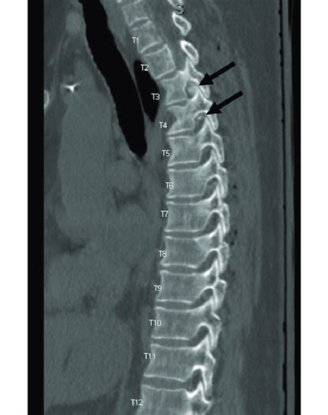 Sagittal Contrast Enhanced Ct Myelogram Of The Thoracic Spine Download Scientific Diagram