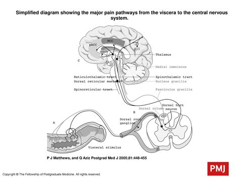 Simplified Diagram Showing The Major Pain Pathways From The Viscera To