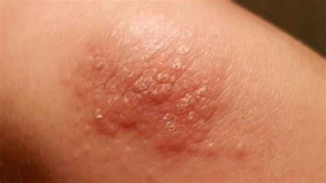 Rash On Elbows And Knees Bumps Arms Eczema How To Get Rid