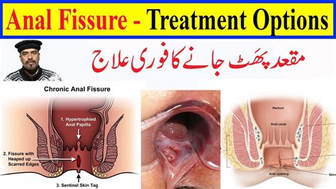 Anal Fissure Treatment In Homeopathy How To Get Rid Of Anal Fissure