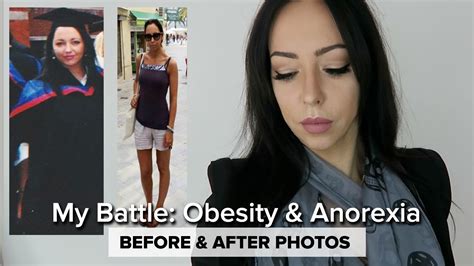 My Story Anorexia And Obesity Journey Youtube