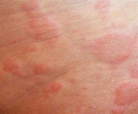 For localized itchy rashes, apply 1% hydrocortisone cream if the rash is not a result of fungus, chicken pox, or bacterial infection. Skin Rashes in Children on Face in Adults on Hands on Arms ...