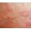 Itchy Skin Rash  Pictures Causes Symptoms Treatment