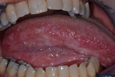 Oral Leukoplakia Opmdcare