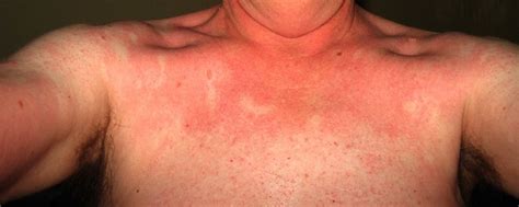 White Bumps On Skin After Sun Exposure Health For You