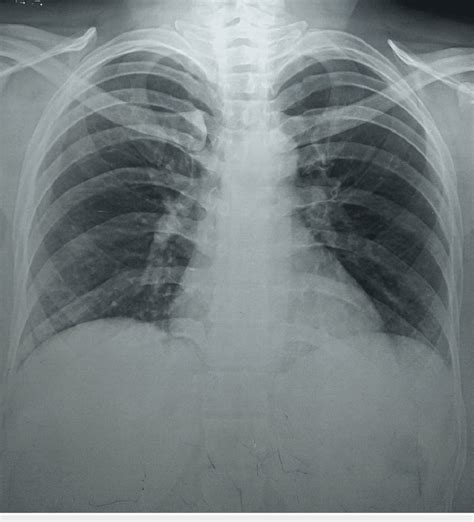 A Normal Chest Radiograph Posteroanterior Pa View Download