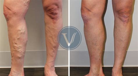 Treatment For Varicose Veins Causuing Leg Pain The Vein Institute