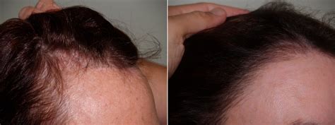 Hair Transplants For Women Before And After Photos Foundation For