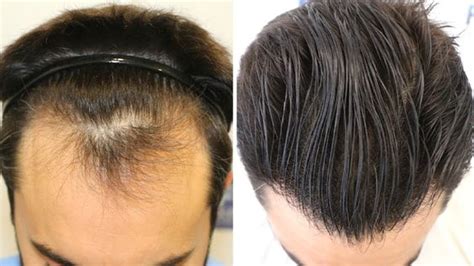Hair Restoration In Turkey Free Consultation Medic Istanbul