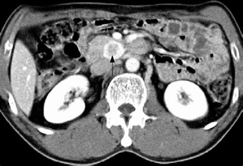 The Ct Scan Of Upper Abdomen Showed An Intense Homogenously Enhancing