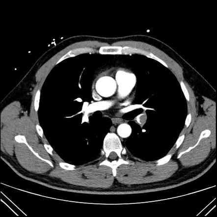 Pulmonary Embolism Spectral CTPA Image Radiopaedia Org