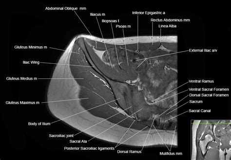 Hip Joint Anatomy Mri