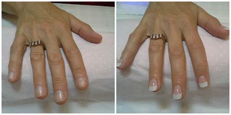 A Great Before And After Picture Of Acrylic Nails Done By Vesela Secret Nails Before And After