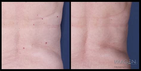 Cherry angioma removal is a commonly performed treatment at centre for surgery in london. cherry angioma @ Bluefern Spa
