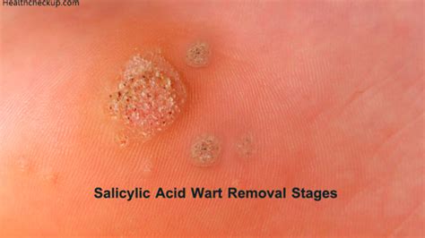 Stages Of Plantar Wart Removal Using Salicylic Acid Types Of Warts