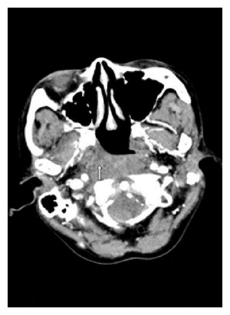 Axial Cect Of The Neck At The Level Of Nasopharynx Showing Asymmetry Of