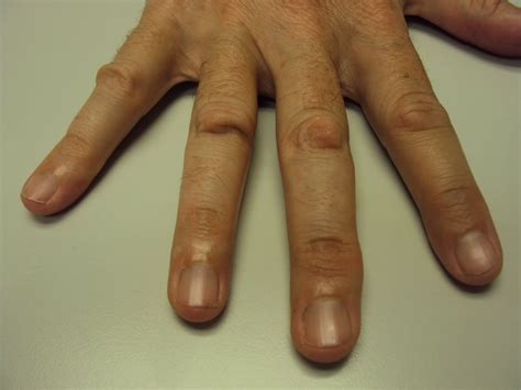 Knuckle Calluses Pictures Photos