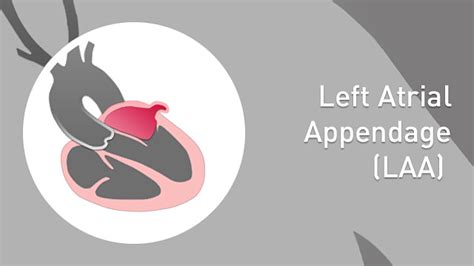 Laa Left Atrial Appendage Closure