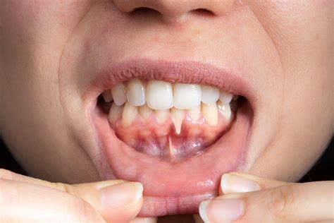 Why Do My Gums Itch Between My Teeth Causes And Treatment