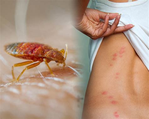 Skin How To Identify Scabies Naturalskins