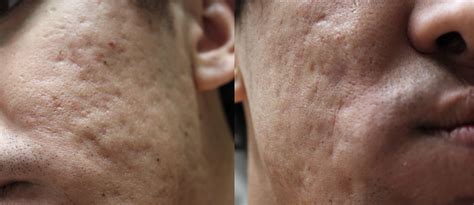 Acne What Could I Do To Fix My Acne Scars Rskincareaddiction