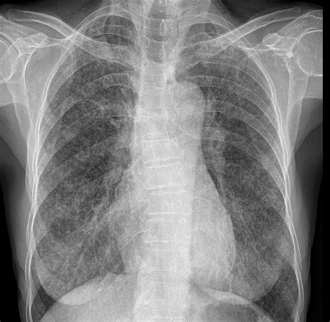 Chest Radiograph Posteroanterior View Revealing Multiple Small