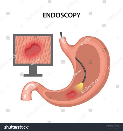 Endoscopy Diagnostic Human Stomach Ulcer Human Stock Vector Royalty Free Shutterstock