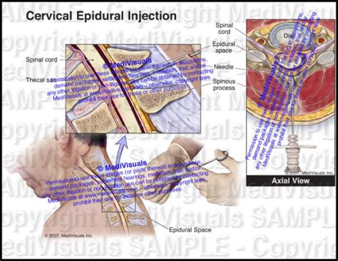 Cervical Epidural Injection Medivisuals Inc
