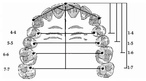 Width And Length Of Palatal Vault And Anterior Arch Circumference