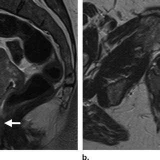 Cervical cancer is the third most common gynecologic malignancy in the united states. FIGO Staging of Cervical Carcinoma | Download Table