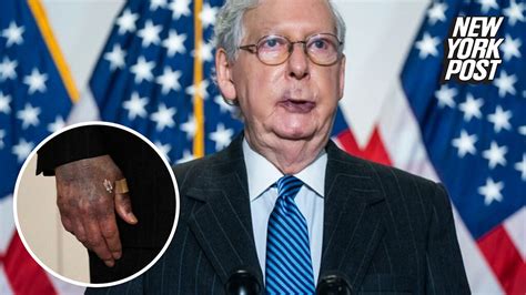 President trump gave senate majority leader mitch mcconnell a vigorous handshake following trump's joint address to congress on feb. Mitch McConnell All Bruised Black And Blue, Both Hands And ...