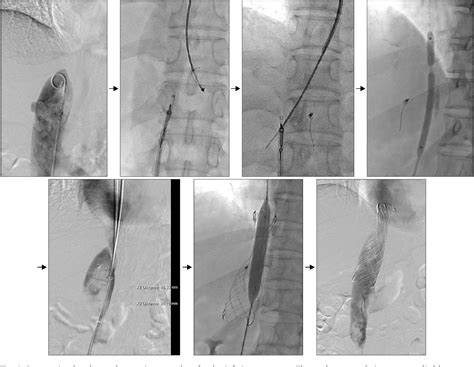 Figure 3 From Endovascular Stenting Of The Inferior Vena Cava In A
