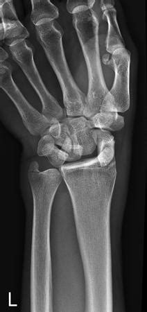 Lunate Dislocation Perilunate Dissociation Hand Orthobullets
