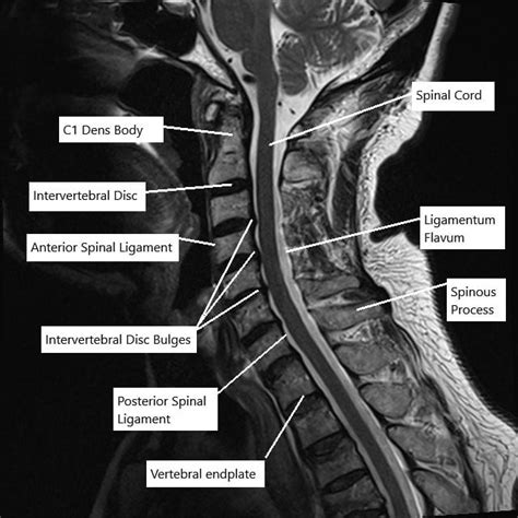 C Spine Anatomy Mri Cervical Spine Sagittal Anatomy Vrogue Co